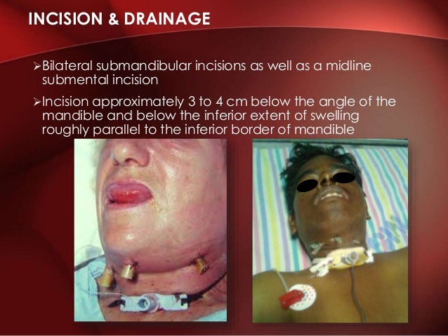ludwig s angina