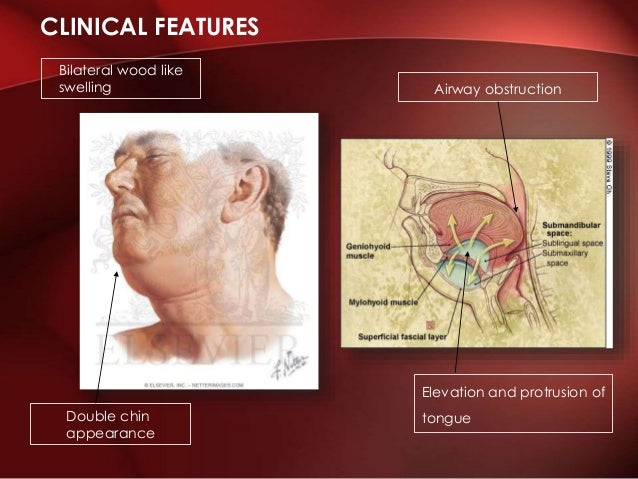 Ludwig’s angina