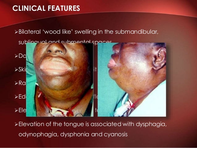 ludwig s angina