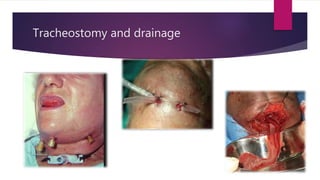 Tracheostomy and drainage
 