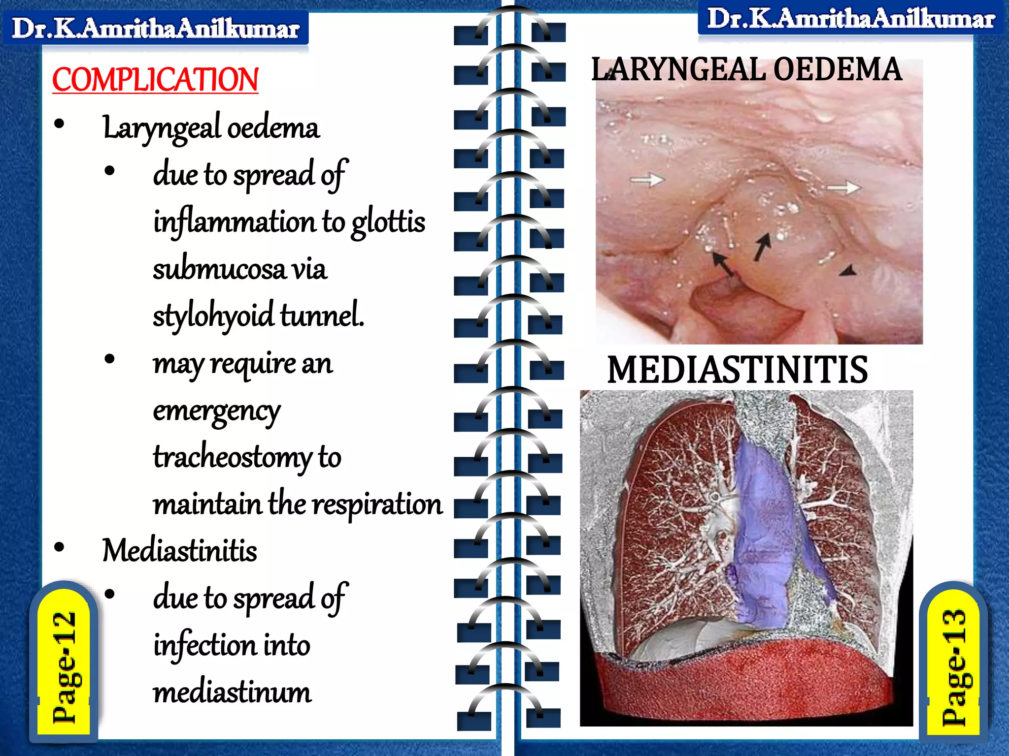 Ludwigs Angina By Dr K AmrithaAnilkumar PPTX