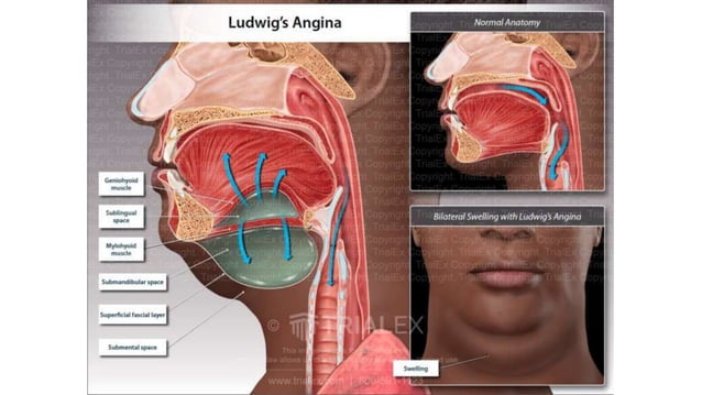 LUDWIG’S ANGINA PRESENTATION CELLULITIS.pptx