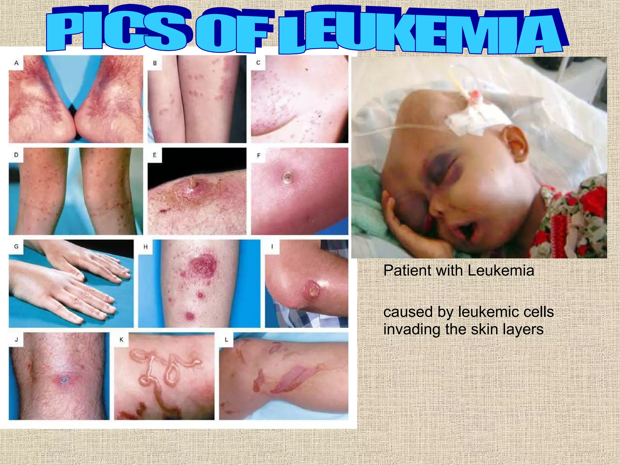 caused by leukemic cells invading the skin layers  Patient with Leukemia PICS OF LEUKEMIA 