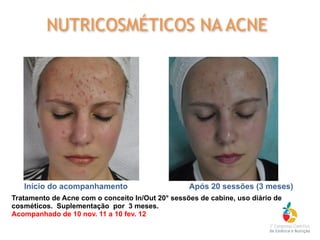 Tratamento de Acne com o conceito In/Out 20° sessões de cabine, uso diário de
cosméticos. Suplementação por 3 meses.
Acompanhado de 10 nov. 11 a 10 fev. 12
Início do acompanhamento Após 20 sessões (3 meses)
NUTRICOSMÉTICOS NA ACNE
 