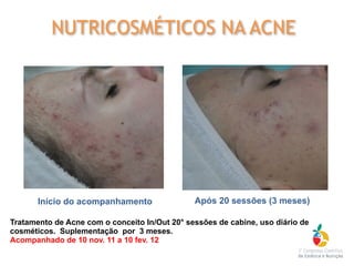 Tratamento de Acne com o conceito In/Out 20° sessões de cabine, uso diário de
cosméticos. Suplementação por 3 meses.
Acompanhado de 10 nov. 11 a 10 fev. 12
Início do acompanhamento Após 20 sessões (3 meses)
NUTRICOSMÉTICOS NA ACNE
 