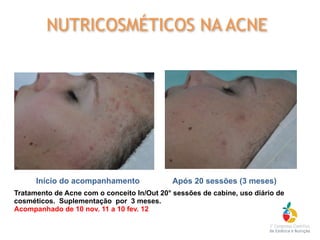 Tratamento de Acne com o conceito In/Out 20° sessões de cabine, uso diário de
cosméticos. Suplementação por 3 meses.
Acompanhado de 10 nov. 11 a 10 fev. 12
Início do acompanhamento Após 20 sessões (3 meses)
NUTRICOSMÉTICOS NA ACNE
 