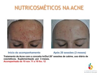 Tratamento de Acne com o conceito In/Out 20° sessões de cabine, uso diário de
cosméticos. Suplementação por 3 meses.
Acompanhado de 10 nov. 11 a 10 fev. 12
Início do acompanhamento Após 20 sessões (3 meses)
NUTRICOSMÉTICOS NA ACNE
 