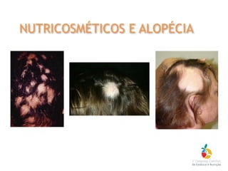 NUTRICOSMÉTICOS E ALOPÉCIA
 