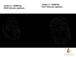 16/04/13 – PARIETAL
2948 folículos capilares
19/06/13 – PARIETAL
5227 folículos capilares
 