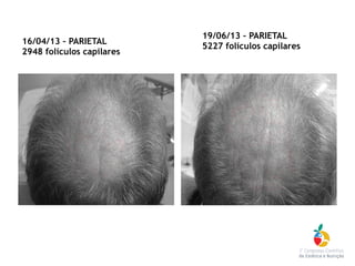 16/04/13 – PARIETAL
2948 folículos capilares
19/06/13 – PARIETAL
5227 folículos capilares
 