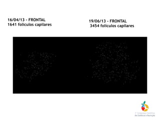 16/04/13 – FRONTAL
1641 folículos capilares
19/06/13 – FRONTAL
3454 folículos capilares
 