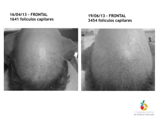 16/04/13 – FRONTAL
1641 folículos capilares
19/06/13 – FRONTAL
3454 folículos capilares
 
