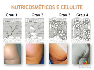 Grau 1 Grau 2 Grau 3 Grau 4
NUTRICOSMÉTICOS E CELULITE
 