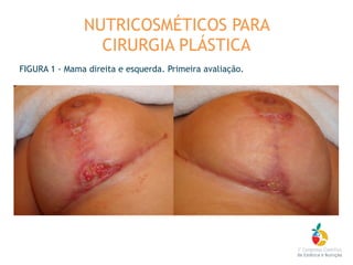 FIGURA 1 - Mama direita e esquerda. Primeira avaliação.
NUTRICOSMÉTICOS PARA
CIRURGIA PLÁSTICA
 