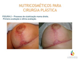 FIGURA 2 – Processo de cicatrização mama direita.
Primeira avaliação e última avaliação.
NUTRICOSMÉTICOS PARA
CIRURGIA PLÁSTICA
 