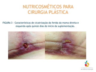 FIGURA 3 – Características de cicatrização da ferida da mama direita e
esquerda após quinze dias do início da suplementação.
NUTRICOSMÉTICOS PARA
CIRURGIA PLÁSTICA
 