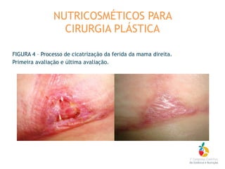FIGURA 4 – Processo de cicatrização da ferida da mama direita.
Primeira avaliação e última avaliação.
NUTRICOSMÉTICOS PARA
CIRURGIA PLÁSTICA
 