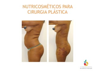 NUTRICOSMÉTICOS PARA
CIRURGIA PLÁSTICA
 