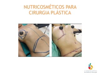 NUTRICOSMÉTICOS PARA
CIRURGIA PLÁSTICA
 