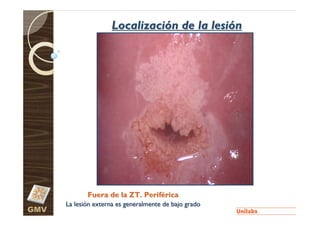 Localización de la lesión




             Fuera de la ZT. Periférica
      La lesión externa es generalmente de bajo grado
GMV
 