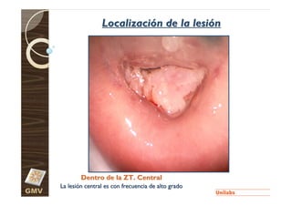 Localización de la lesión




              Dentro de la ZT. Central
      La lesión central es con frecuencia de alto grado
GMV
 