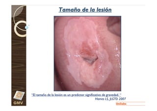 Tamaño de la lesión




      “El tamaño de la lesión es un predictor significativo de gravedad. “
                                                       Hames LS, JLGTD 2007
GMV
 
