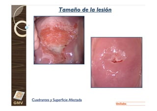 Tamaño de la lesión




      Cuadrantes y Superficie Afectada
GMV
 