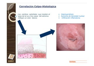 Correlación Colpo-Histológica


      Los cambios epiteliales que impiden el   •   Hiperqueratosis
      paso de la luz a los vasos del estroma   •   Aumento de densidad nuclear
      reflejan un color blanco                 •    Infiltración inflamatoria




GMV
 