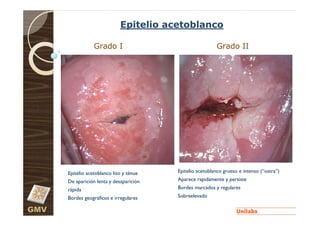 Epitelio acetoblanco

                  Grado I                                  Grado II




      Epitelio acetoblanco liso y ténue   Epitelio acetoblanco grueso e intenso (“ostra”)
      De aparición lenta y desaparición   Aparece rapidamente y persiste
      rápida                              Bordes marcados y regulares
      Bordes geográficos e irregulares    Sobreelevado

GMV
 