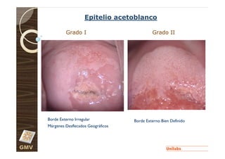 Epitelio acetoblanco

               Grado I                            Grado II




      Borde Externo Irregular            Borde Externo Bien Definido
      Márgenes Desflecados Geográficos




GMV
 