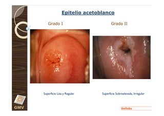 Epitelio acetoblanco

         Grado I                          Grado II




      Superficie Lisa y Regular    Superficie Sobreelevada, Irregular



GMV
 