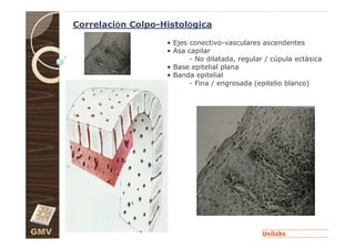 Correlación Colpo-Histológica

                         • Ejes conectivo-vasculares ascendentes
                         • Asa capilar
                                - No dilatada, regular / cúpula ectásica
                         • Base epitelial plana
                         • Banda epitelial
                                - Fina / engrosada (epitelio blanco)




GMV
 