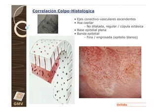 Correlación Colpo-Histológica

                         • Ejes conectivo-vasculares ascendentes
                         • Asa capilar
                                - No dilatada, regular / cúpula ectásica
                         • Base epitelial plana
                         • Banda epitelial
                                - Fina / engrosada (epitelio blanco)




GMV
 