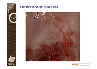 Correlación Colpo-Histológica




GMV
 