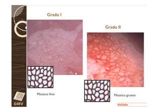 Grado I

                      Grado II




      Mosaico fino        Mosaico grueso

GMV
 
