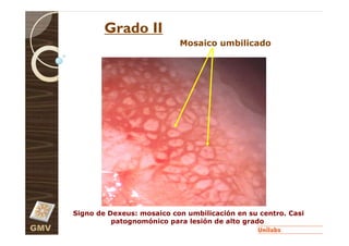Grado II
                                 Mosaico umbilicado




      Signo de Dexeus: mosaico con umbilicación en su centro. Casi
                patognomónico para lesión de alto grado
GMV
 