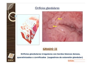 Orificios glandulares




                               GRADO II
         Orificios glandulares irregulares con bordes blancos densos,
      queratinizados o cornificados (sugestivos de extensión glandular)
GMV
 