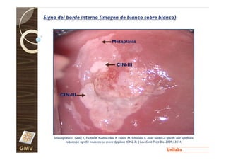 Metaplasia



                                                         CIN-III




           CIN-III




      Scheungraber C, Glutig K, Fechtel B, Kuehne-Heid R, Duerst M, Schneider A. Inner border--a specific and significant
                                           Kuehne-                                     border--a
              colposcopic sign for moderate or severe dysplasia (CIN2-3). J Low Genit Tract Dis. 2009;13:1-4.
                                                                (CIN2-                           2009;13:1-

GMV
 