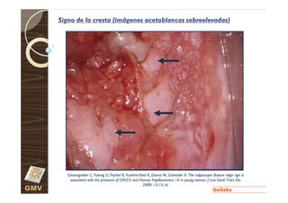 Scheungraber C, Koenig U, Fechtel B, Kuehne-Heid R, Duerst M, Schneider A. The colposcopic feature ridge sign is
                                           Kuehne-                                                             sign
       associated with the presence of CIN2/3 and Human Papillomavirus 16 in young women. J Low Genit Tract Dis.
                                                    2009; 13:13-16.
                                                           13:13-
GMV
 