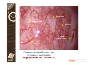 Punteado
                   Ep.
               Acetoblanco
                                                       Mosaico




                                               Criptas
                                            glandulares
                   Vasos
                  atípicos




       Patrón mixto, con diferentes tipos
           de imágenes superpuestas
      Sugestivo de ALTO GRADO
GMV
 