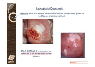 Leucoplasia/Queratosis
      Definición: es un área epitelial de color blanco visible a simple vista, que no se
                             modifica con el acético o el lugol.




       SOLO BIOPSIAR SI se encuentra por
       dentro de la ZT o si se asocia a otras
                     lesiones.


GMV
 