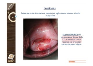 Erosiones
      Definición: zona demudada de epitelio por algún trauma anterior o lesión
                                   subyacente




                                                        SOLO BIOPSIAR SI se
                                                      encuentra por dentro de la
                                                        ZT, si se asocia a otras
                                                        lesiones o si presentan
                                                       vascularizaciones atípicas.




GMV
 