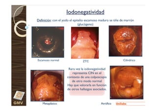 Iodonegatividad
      Definición: con el yodo el epitelio escamoso maduro se tiñe de marrón
                                     (glucógeno)




      Escamoso normal                 ZTC                          Cilíndrico

                            Rara vez la iodonegatividad
                              representa CIN en el
                           contexto de una colposcopia
                              de otro modo normal
                           Hay que valorarla en función
                           de otros hallazgos asociados.



GMV       Metaplásico                              Atrófico
 