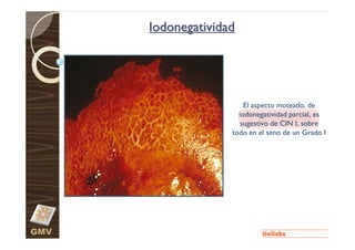 Iodonegatividad




                        El aspecto moteado, de
                      iodonegatividad parcial, es
                       sugestivo de CIN I, sobre
                    todo en el seno de un Grado I




GMV
 