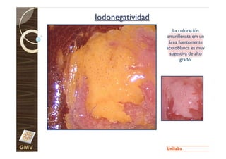 Iodonegatividad
                           La coloración
                        amarillenata em un
                         área fuertemente
                        acetoblanca es muy
                         sugestiva de alto
                               grado.




GMV
 