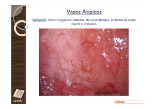 Vasos Atípicos
      Definición: Vasos irregulares, dilatados, de curso abrupto, en forma de coma,
                                    espiral o tirabuzón.




GMV
 