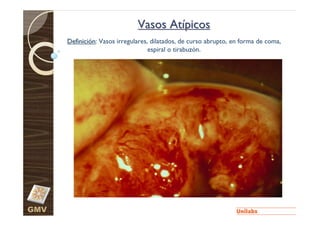 Vasos Atípicos
      Definición: Vasos irregulares, dilatados, de curso abrupto, en forma de coma,
                                    espiral o tirabuzón.




GMV
 