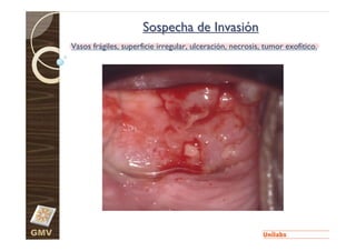 Sospecha de Invasión
      Vasos frágiles, superficie irregular, ulceración, necrosis, tumor exofítico.




GMV
 