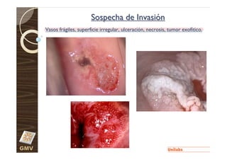 Sospecha de Invasión
      Vasos frágiles, superficie irregular, ulceración, necrosis, tumor exofítico.




GMV
 