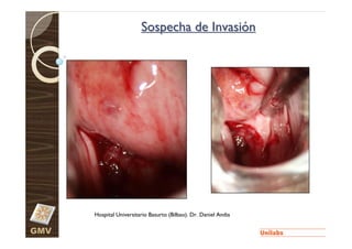 Sospecha de Invasión




      Hospital Universitario Basurto (Bilbao). Dr. Daniel Andia

GMV
 